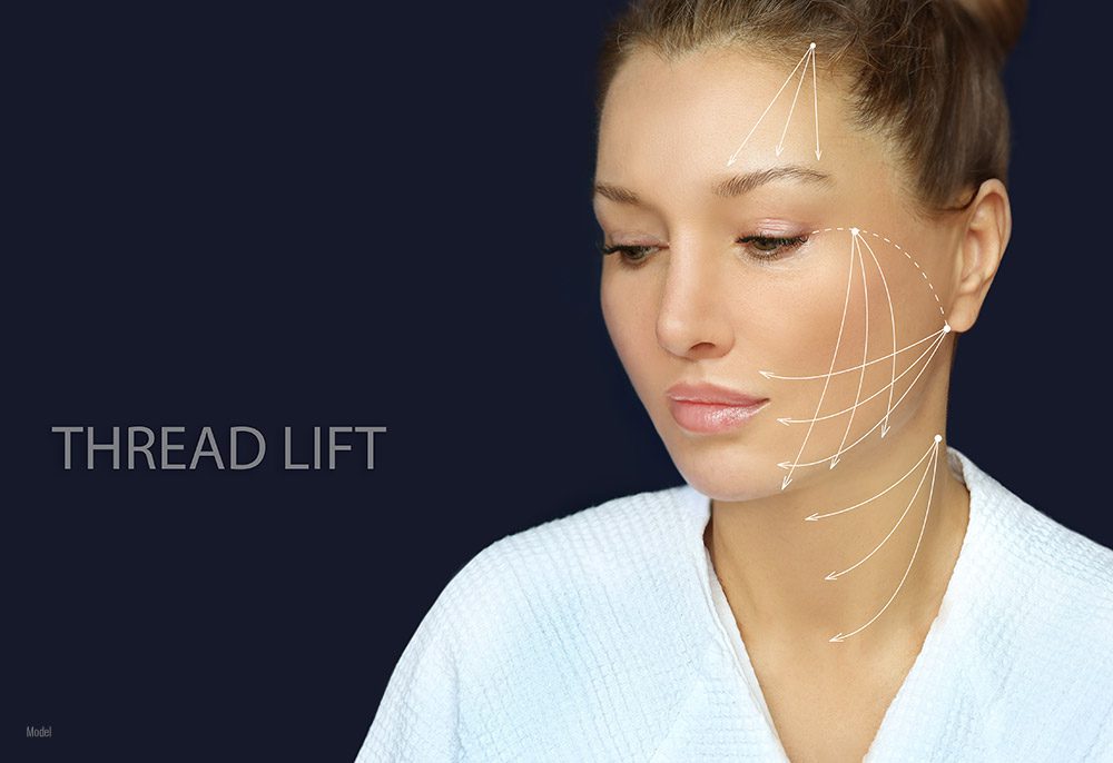 A beautiful woman in white is pictured against a black background with lines showing the direction of lift provided by thread lifts.