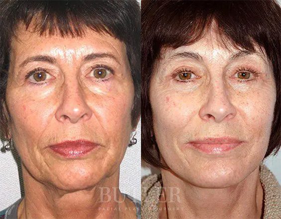 Before and after facelift surgery photo