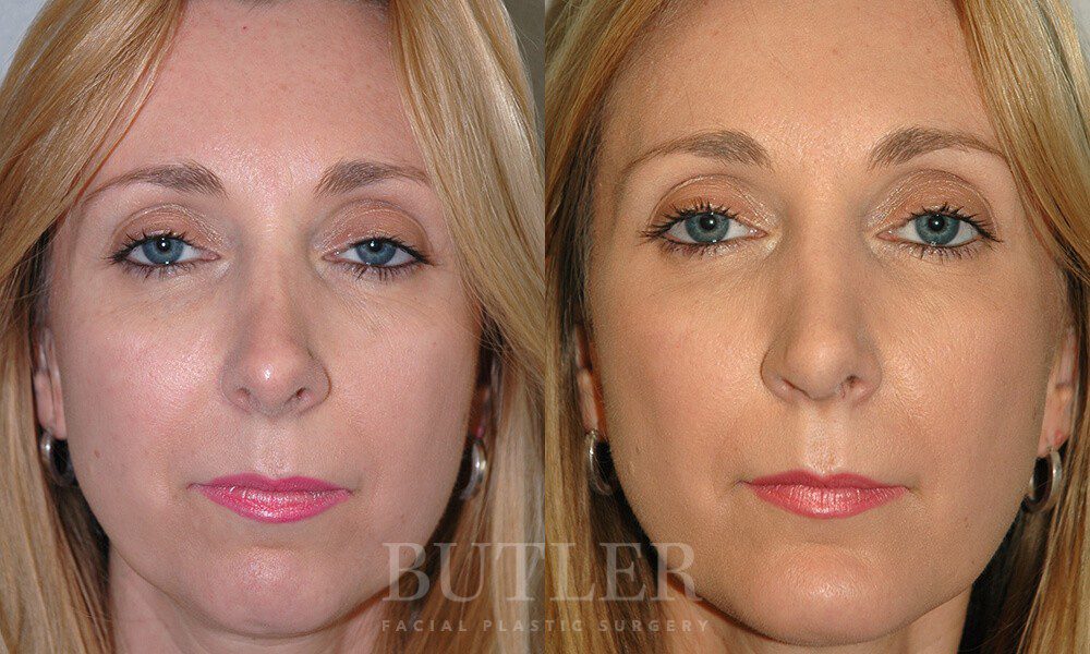 Revision Rhinoplasty Archives - David M. Butler MD Plastic Surgery