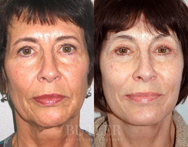 Facelift Patient 10 David M Butler Md Plastic Surgery